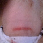 Travis-Ankle